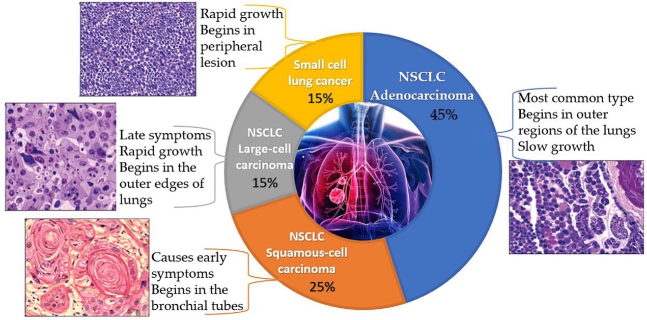 Types of Lung Cancer